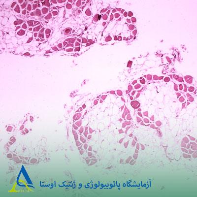دیستروفی عضلانی دوشن (DMD)