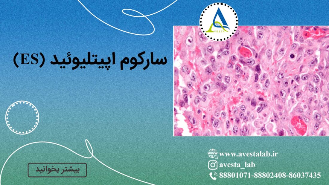 سارکوم اپیتلیوئید (ES) چیست؟ علت، علائم، تشخیص و درمان موثر