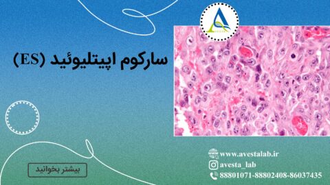 سارکوم اپیتلیوئید (ES) چیست؟ علت، علائم، تشخیص و درمان موثر