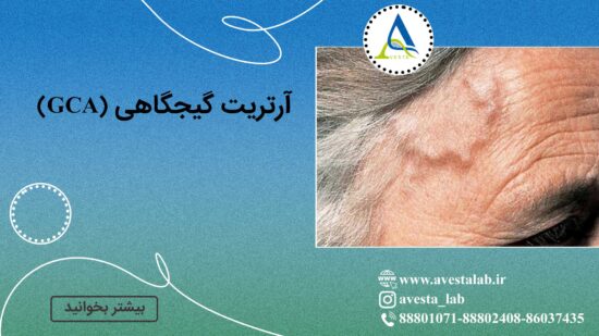 آرتریت گیجگاهی (GCA)