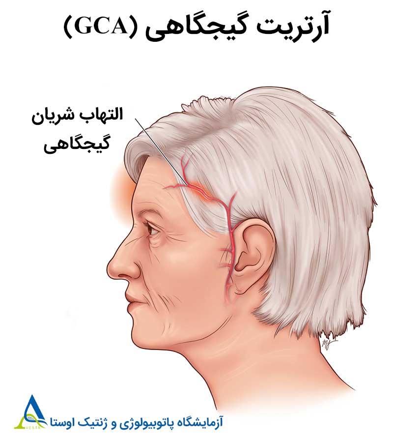 آرتریت گیجگاهی (GCA)