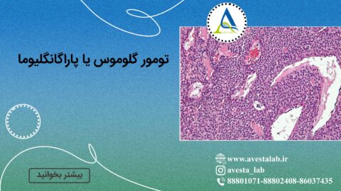 تومور گلوموس یا پاراگانگلیوما