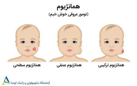 همانژیوم