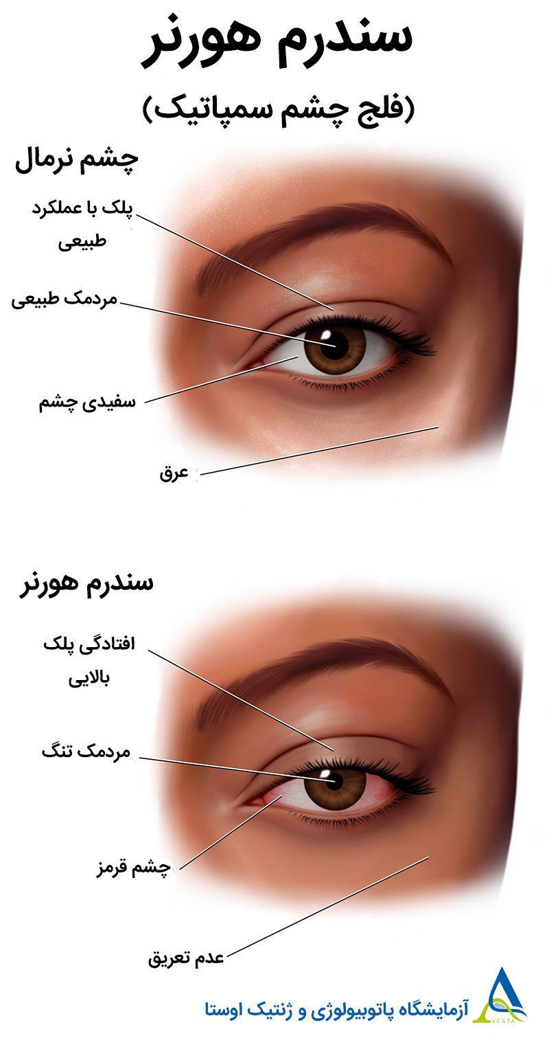 سندرم هورنر