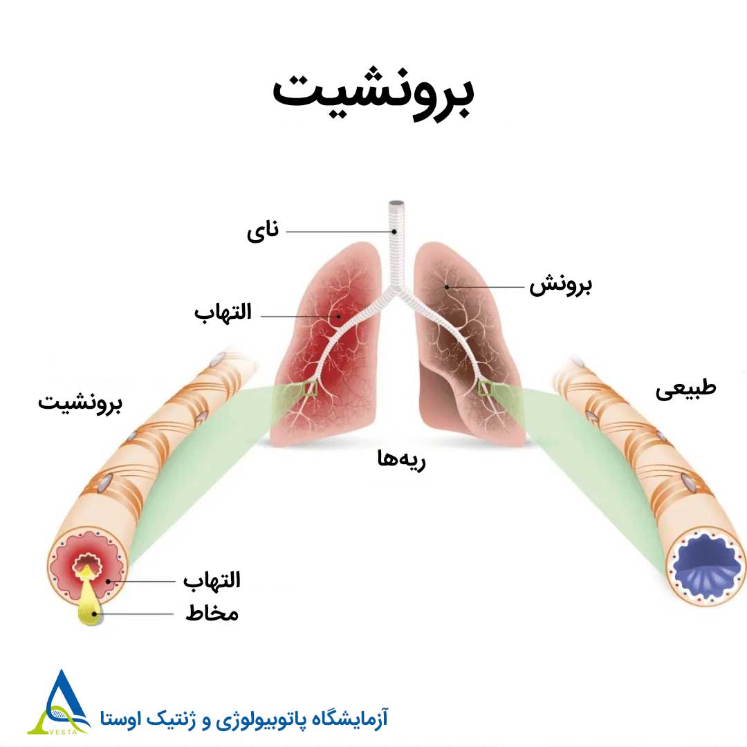 آیا برونشیت مسری است؟