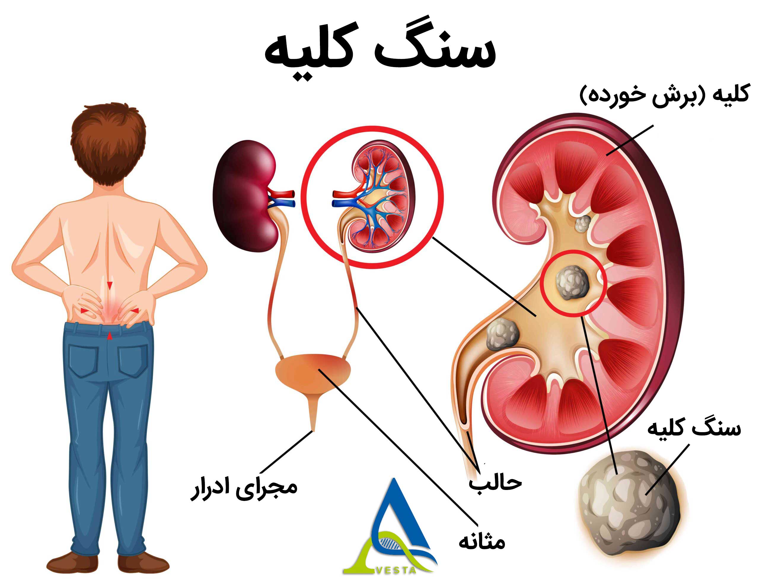 علائم و درمان سنگ کلیه