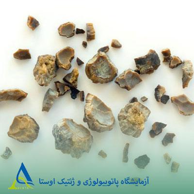 علائم و درمان سنگ کلیه