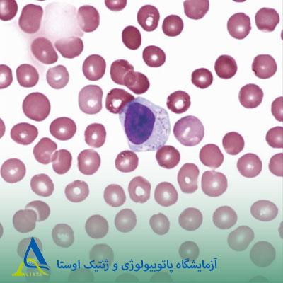 لوسمی لنفوسیتی گرانول بزرگ (LGL)
