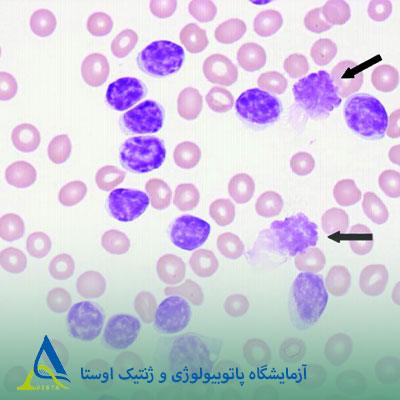 لنفوسیتوز