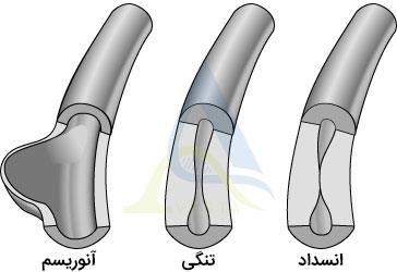 پلی‌آنژیت میکروسکوپی (MPA)