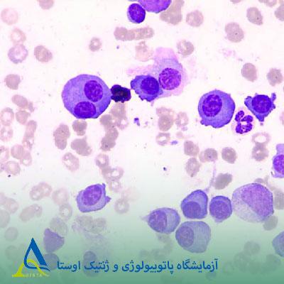 مولتیپل میلوما و آمیلوئیدوز