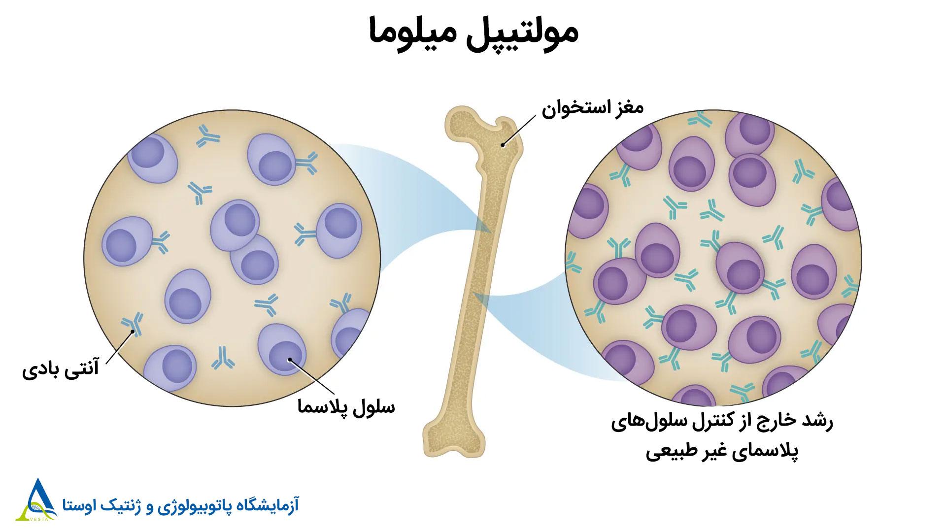 مولتیپل میلوما و آمیلوئیدوز