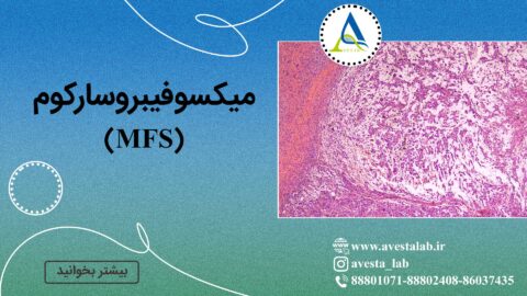 میکسوفیبروسارکوم (MFS)