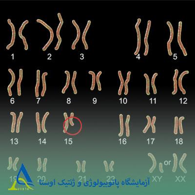 سندرم پرادر-ویلی