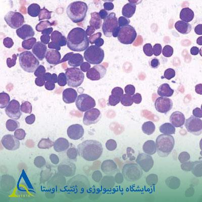 مولتیپل میلوما اسمولدرینگ (SMM)