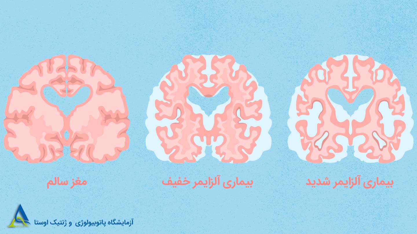 علائم آلزایمر در مراحل اولیه