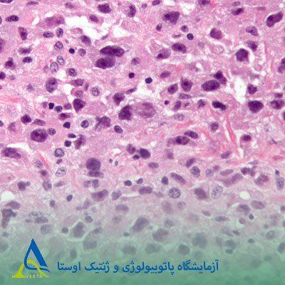 سارکوم پلئومورفیک تمایز نیافته (UPS)