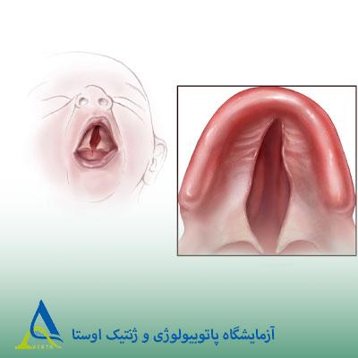 سندرم کابوکی