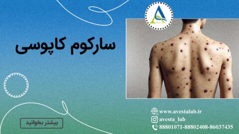 سارکوم کاپوسی