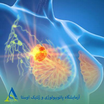 علائم سرطان سینه در مراحل اولیه