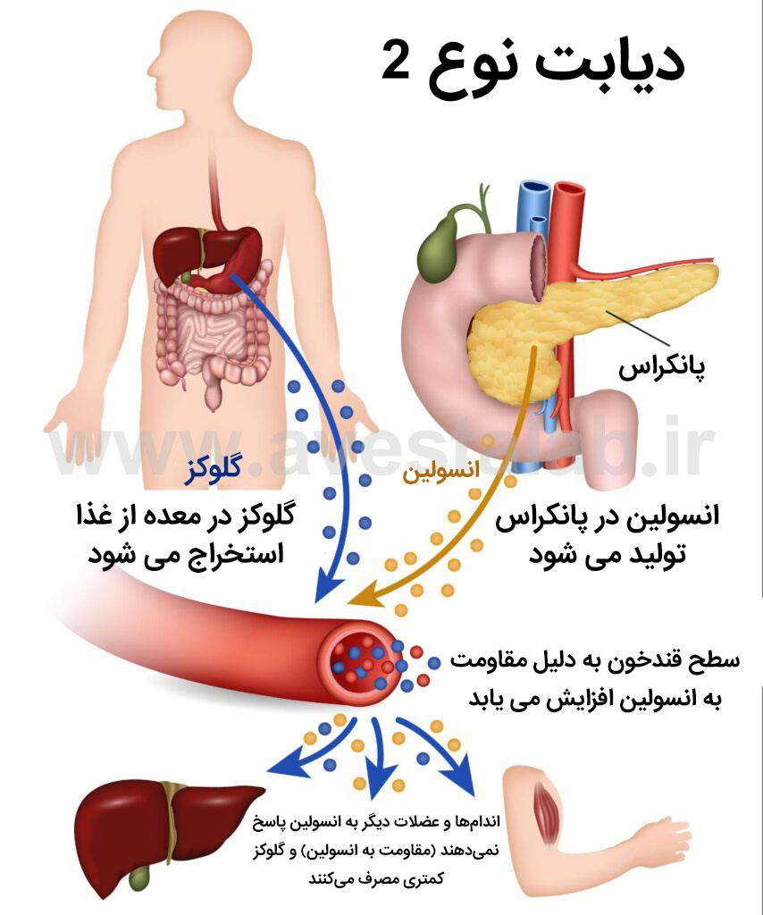 دیابت نوع 2 چیست و چه علائمی دارد؟