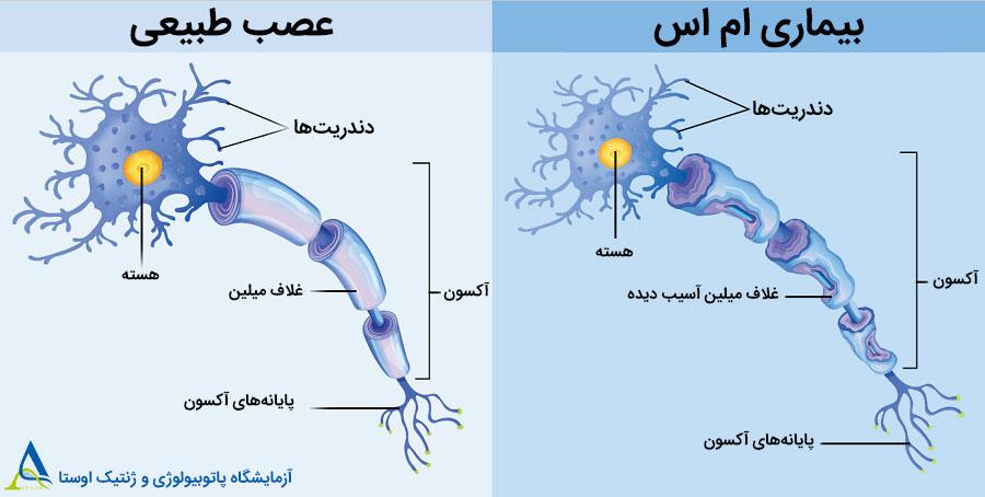 آیا بیماری ام اس باعث فلجی می شود؟