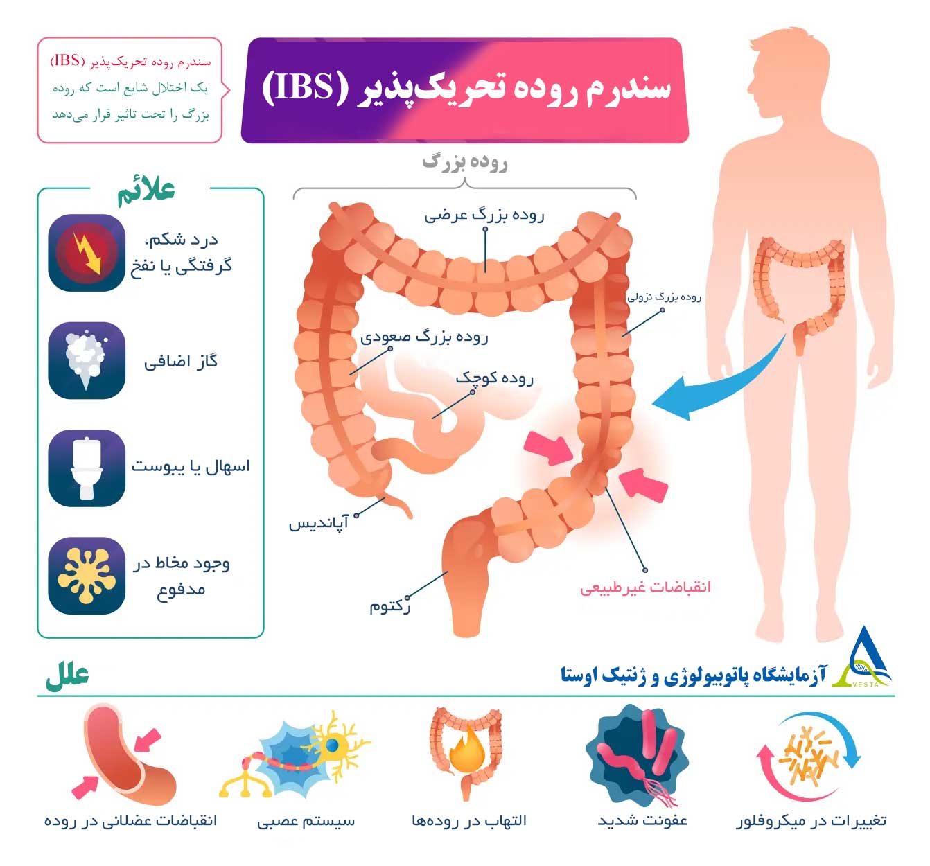 سندرم روده تحریک‌پذیر (IBS)؛ علل، علائم، تشخیص و درمان