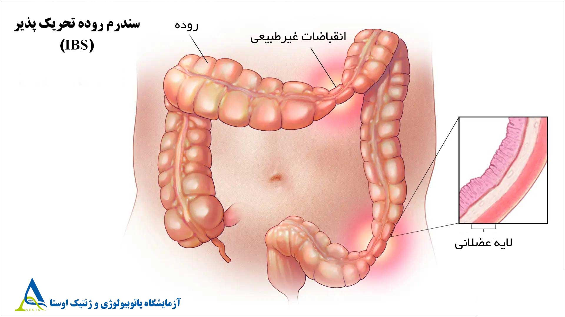 سندرم روده تحریک‌پذیر (IBS)؛ علل، علائم، تشخیص و درمان