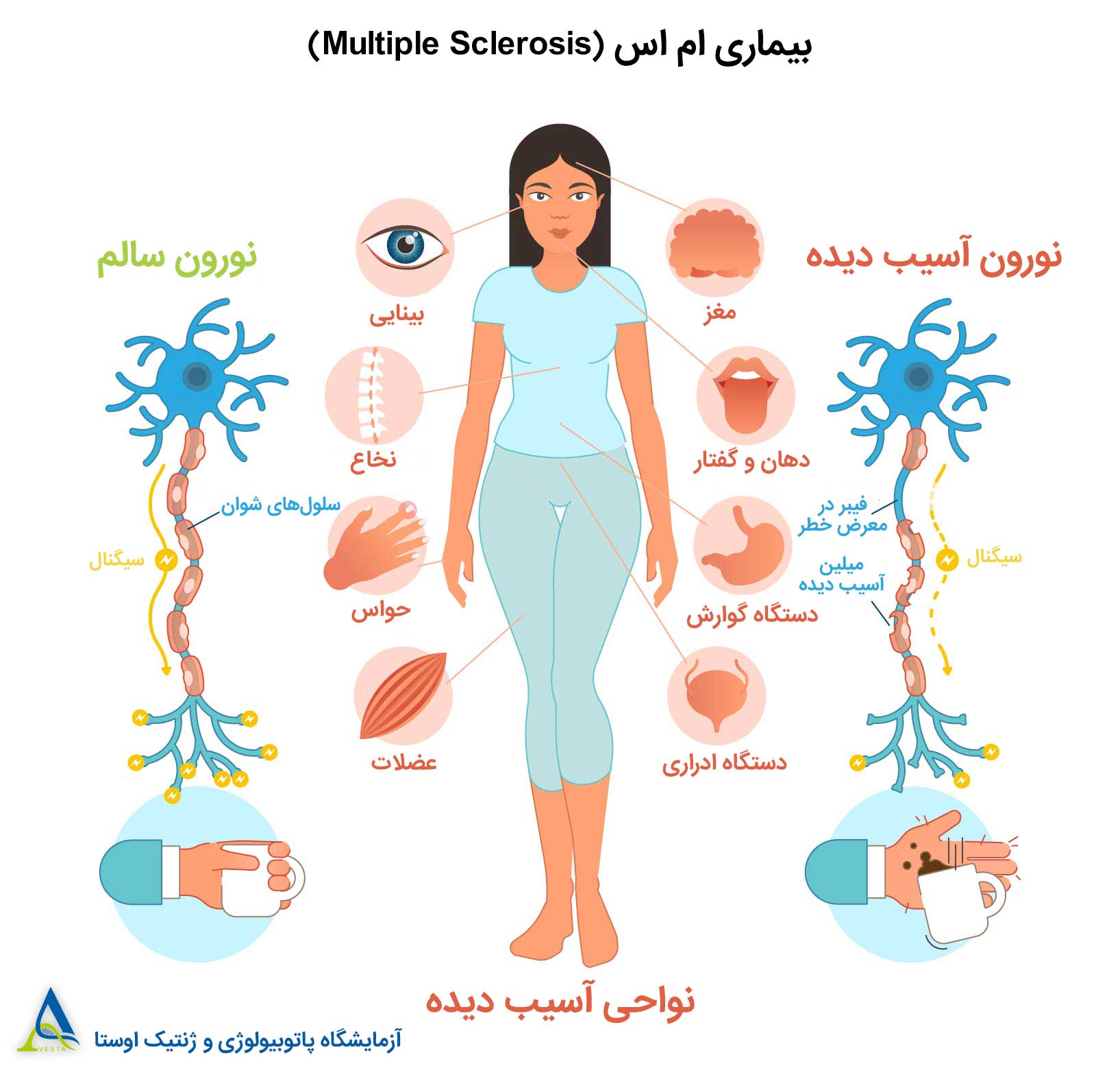 علائم بیماری ام اس (MS)