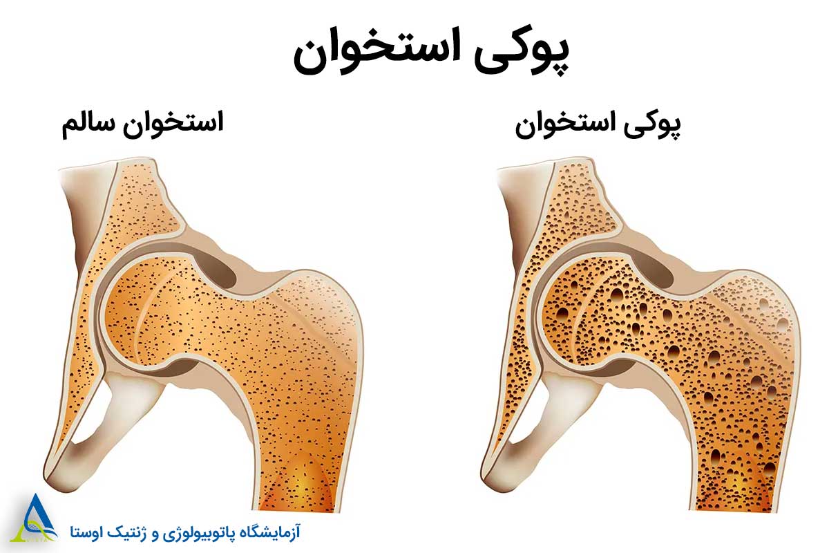علائم پوکی استخوان و راه‌های پیشگیری