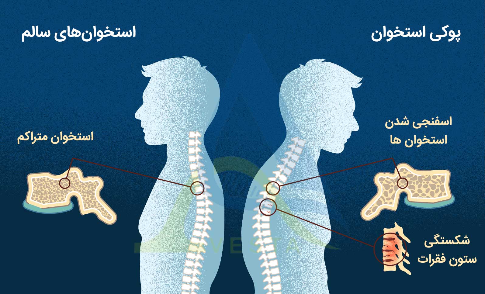 علائم پوکی استخوان و راه‌های پیشگیری