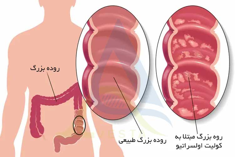کولیت اولسراتیو (Ulcerative Colitis)