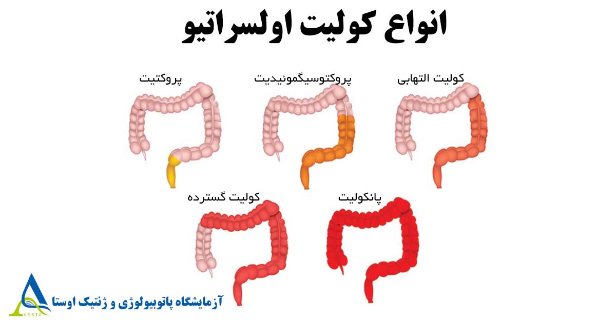 کولیت اولسراتیو (Ulcerative Colitis)