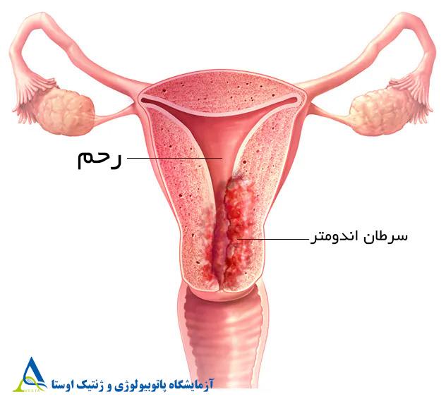 سرطان اندومتر (سرطان رحم)؛ علل، علائم، درمان و تشخیص