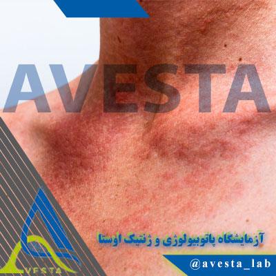 سندرم دِرِس DRESS چیست؟ علت‌ها، علائم، تشخیص و درمان
