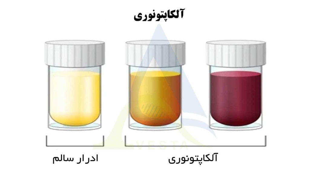 آلکاپتونوری چیست؟