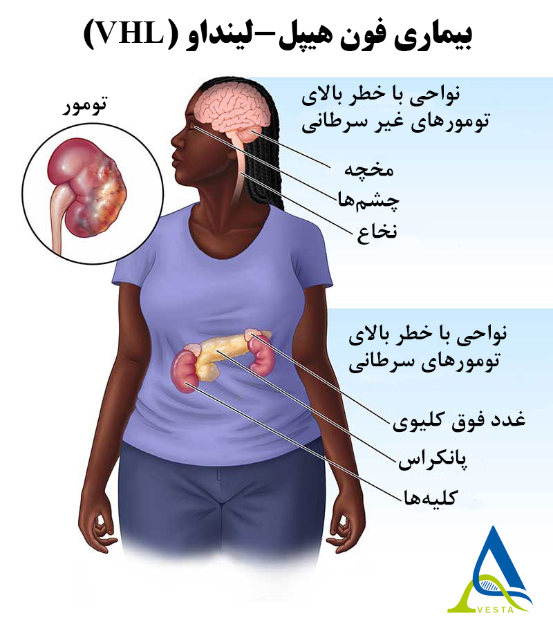 بیماری فون هیپل-لینداو (VHL)؛ علائم، علت، راه‌های تشخیص و درمان