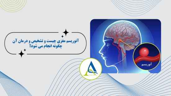 آنوریسم مغزی چیست و تشخیص و درمان آن چگونه انجام می شود؟