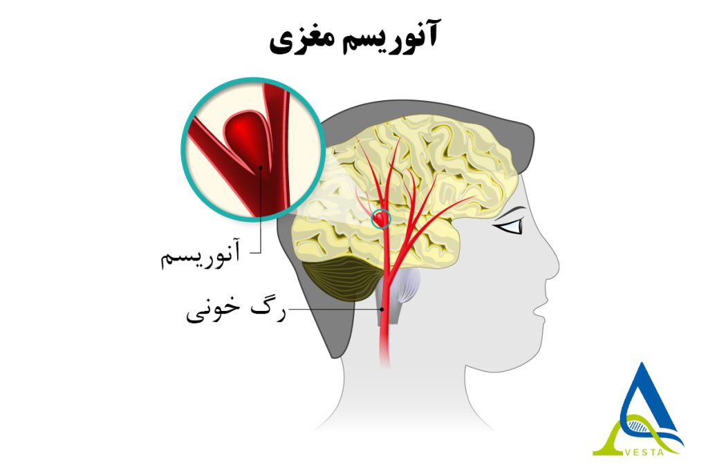 آنوریسم مغزی چیست و تشخیص و درمان آن چگونه انجام می شود؟