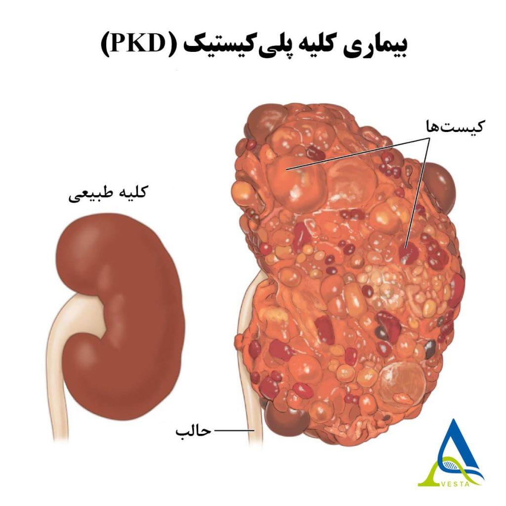 بیماری کلیه پلی کیستیک (PKD)؛ علائم، خطرات و گزینه‌های درمان