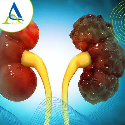 بیماری کلیه پلی کیستیک (PKD)؛ علائم، خطرات و گزینه‌های درمان