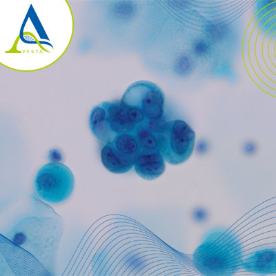 تشخیص ویروس HPV در مردان با نمونه ادرار | روشی آسان برای شناسایی زگیل تناسلی
