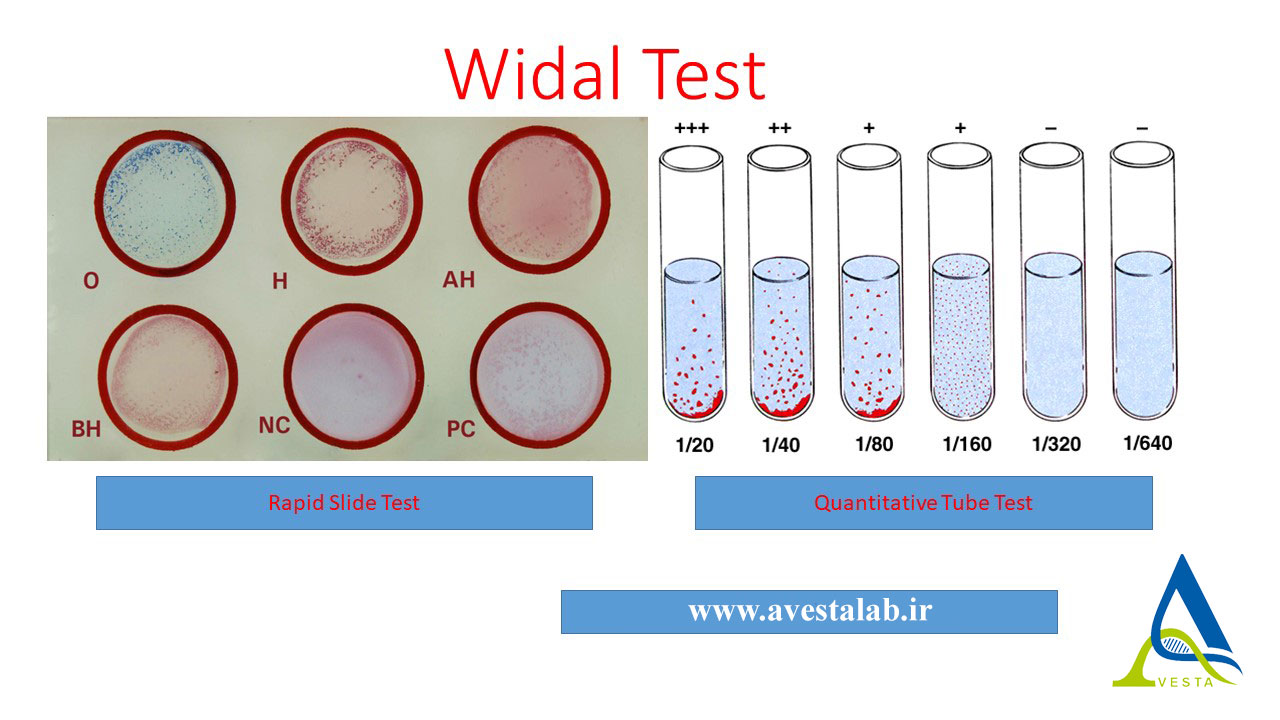 آزمایش ویدال (Widal Test) چیست؟ کاربرد، نحوه انجام، تفسیر نتایج و مقادیر نرمال