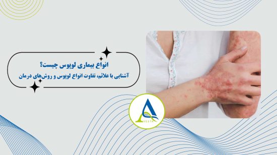 انواع بیماری لوپوس چیست؟ آشنایی با علائم، تفاوت انواع لوپوس و روش‌های درمان