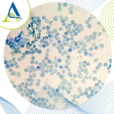 آزمایش شمارش رتیکولوسیت (Reticulocyte Count) چیست؟ تفسیر رتیکولوسیت بالا و پایین